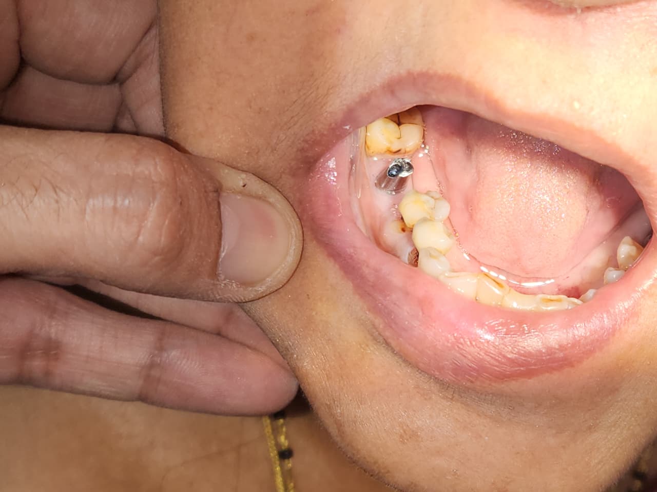 dental implants clinic near me 2026