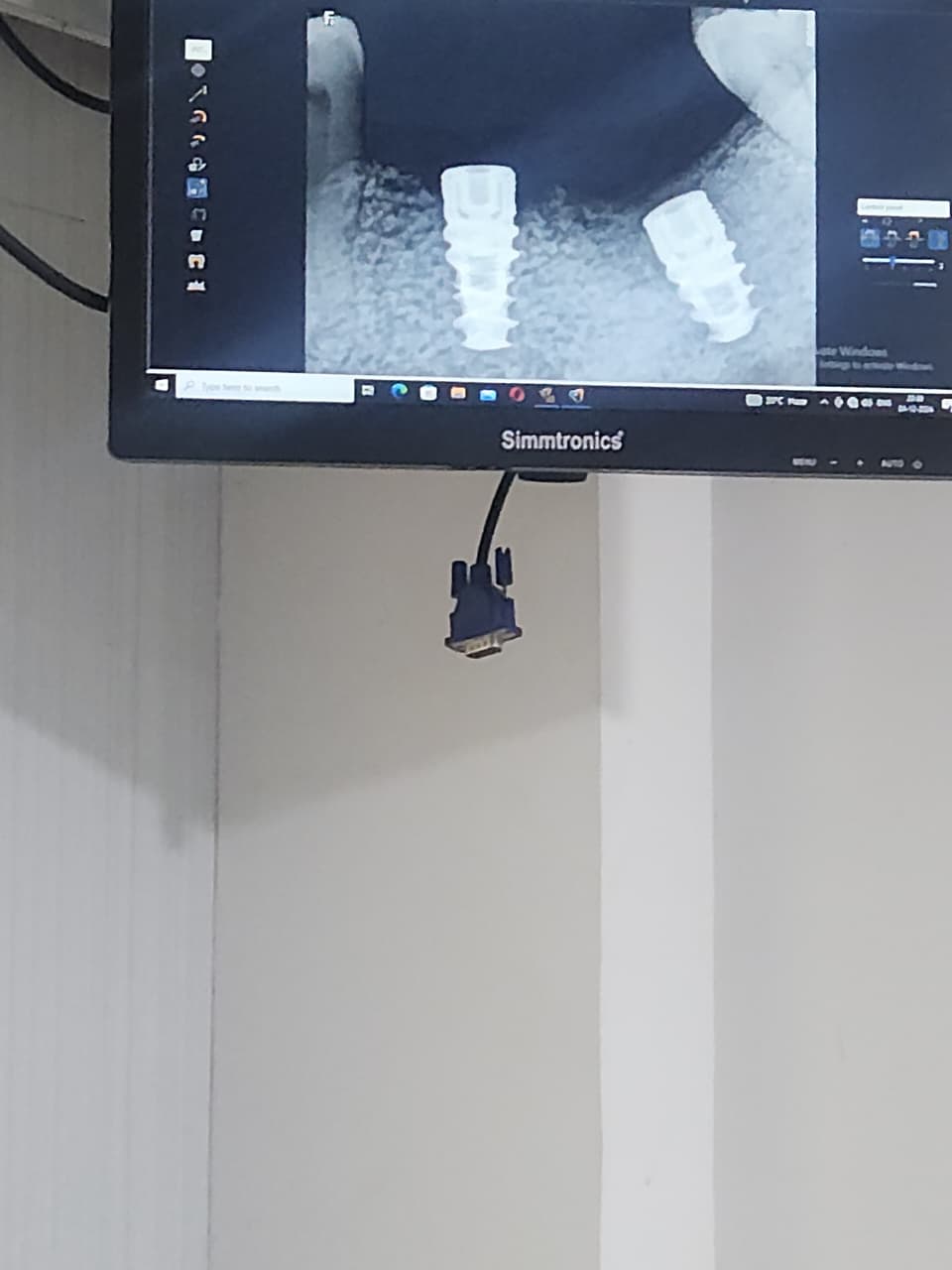 dental implants treatment center nagpur