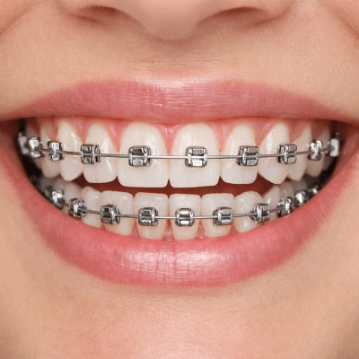 best braces for teeth 2026
